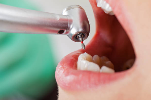 Best Chipped Tooth Repair Near Me  in Boyes Hot Springs, CA
